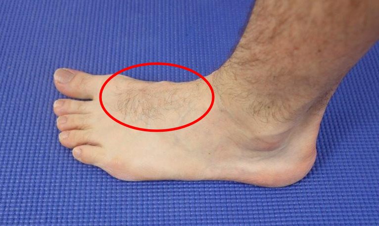 Pain in top side 2025 of foot when walking