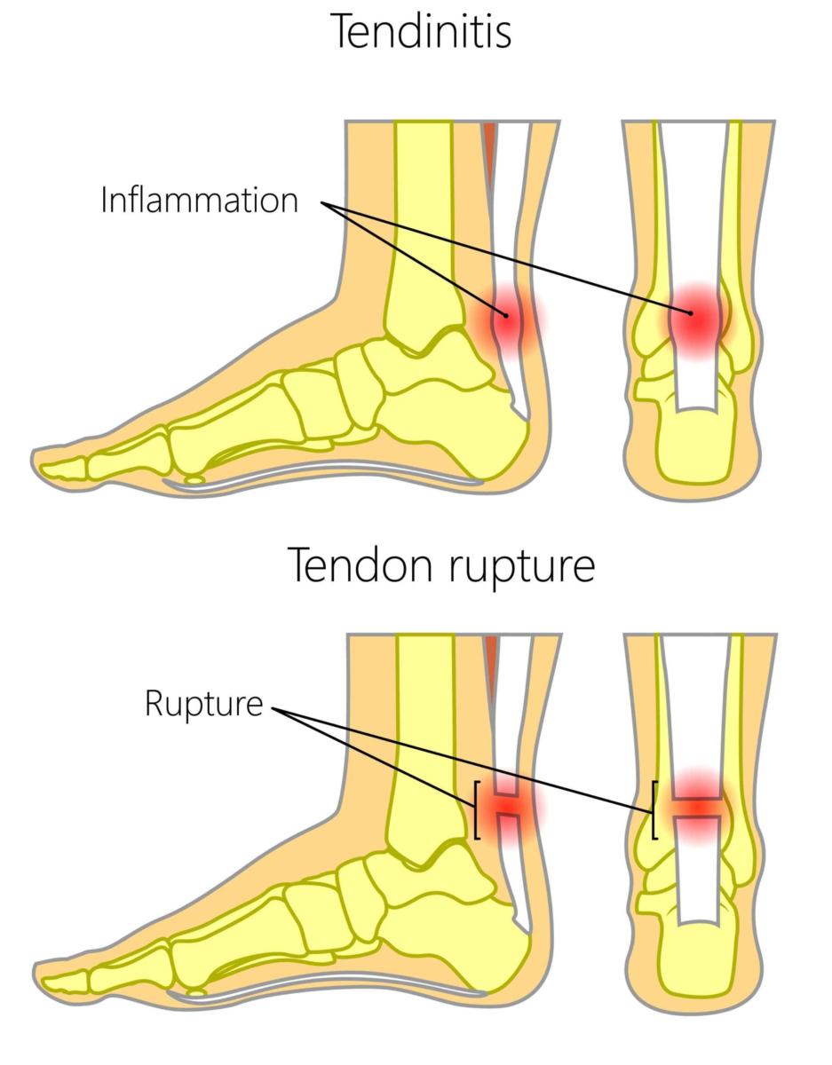 Hard lump clearance on achilles tendon