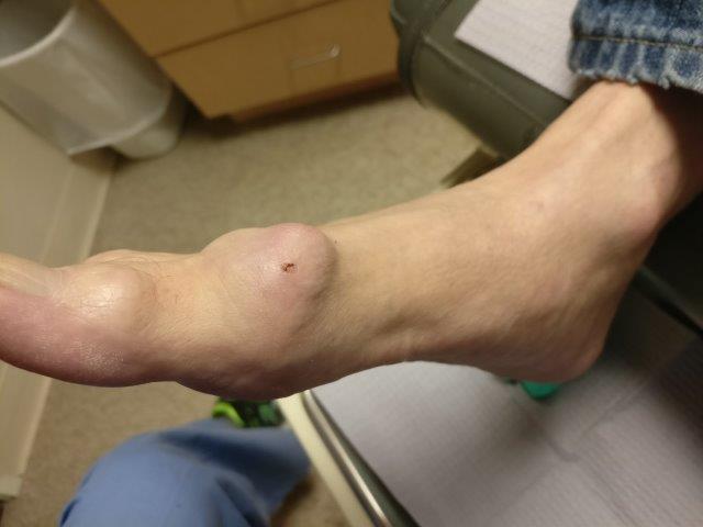 bony growth on top of foot