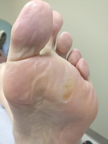 Hard spot on deals sole of foot