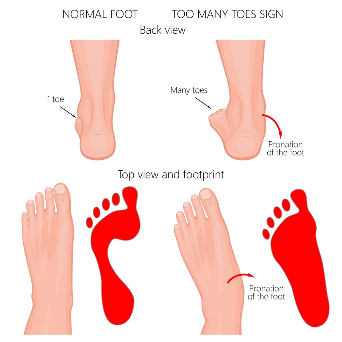 Insoles for hot sale extensor tendonitis