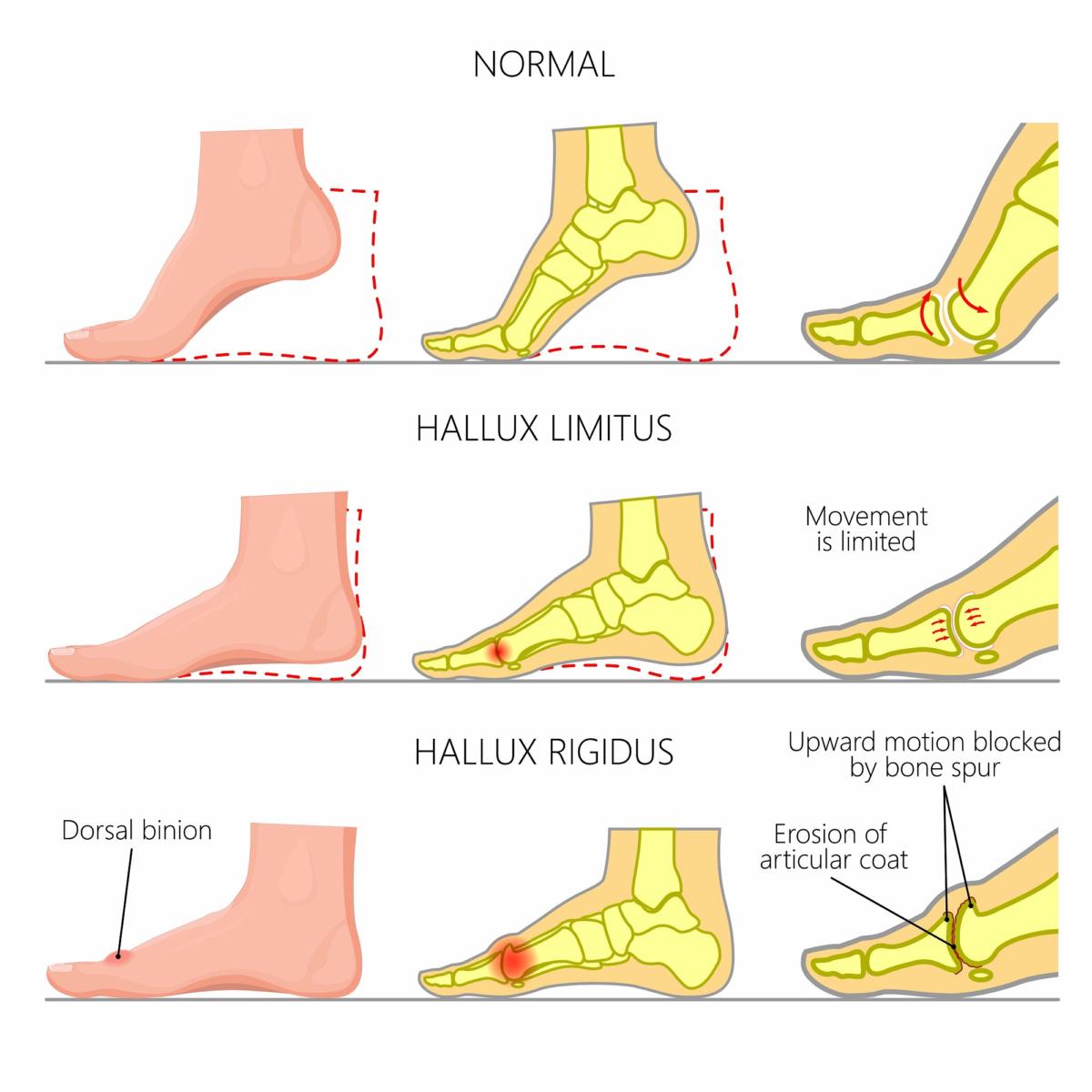 Best boots for hallux on sale rigidus