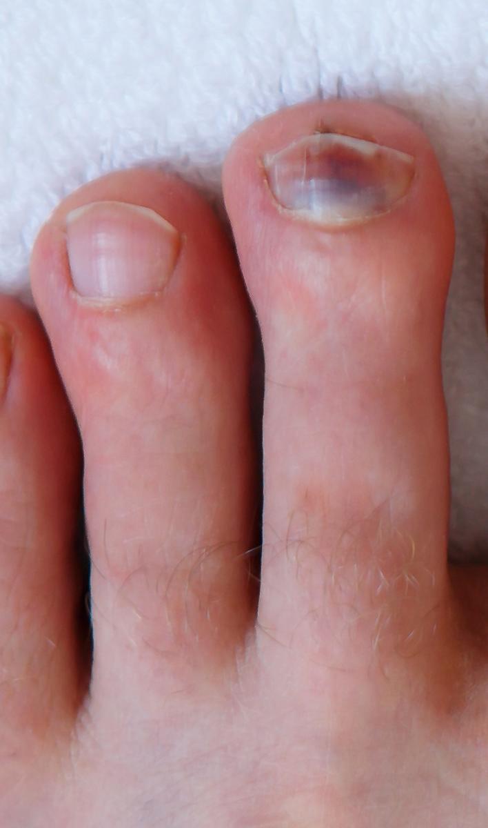 Toe Nail Coming Off The Nail Bed [Causes, Remedies & Best Treatment!]