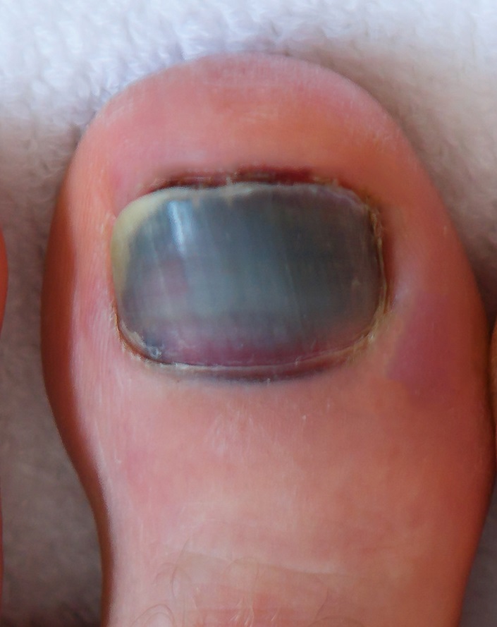 Black Bruised Toenail Bleeding Causes Symptoms Best Treatment