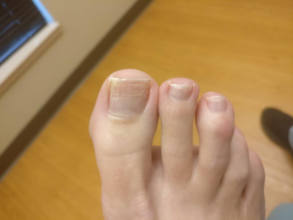 White Spots On Toenails After Removing Nail Polish   Img 20191126 143551 