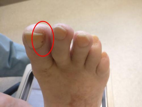 Toenail Falling Off Running: [Causes, Symptoms & Best Treatment!]