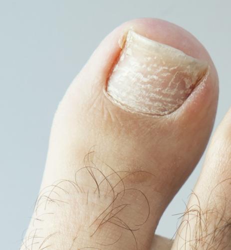 White nails: Superficial white onychomycosis, white spots, white marks & white toenail fungus. This toenail has horizontal ridges and horizontal white lines.