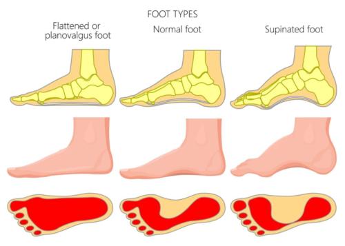 flat foot ankle pain