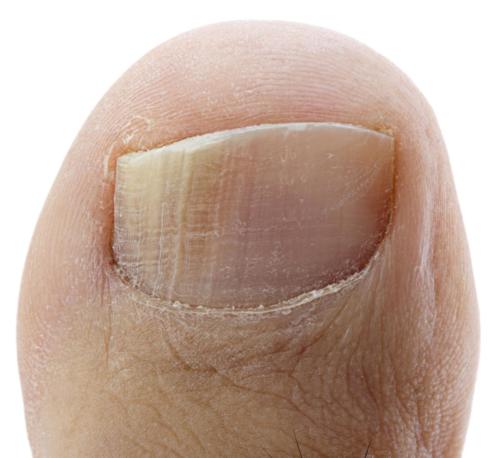 Toenail Fungus Nail Falling Off [Causes, Signs & Best Home Treatment!]