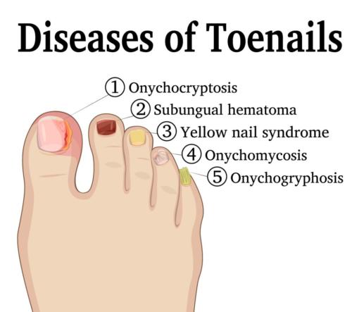 How To Fix An Ingrown Toenail Permanently[Podiatrist Home & Surgery Tips!]