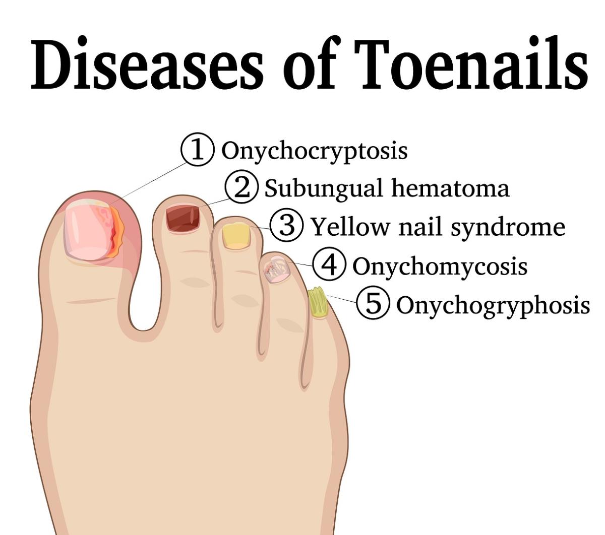 Curved Toenail Treatment The Complete Ingrown Toenail Guide   Toenail Disease Ingrown Toenail Hematoma Yellow Toenail Onygryphosis 1 (1) (1) 