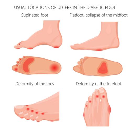 neuropathy - Balance Foot & Ankle Specialists